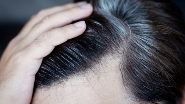 Genetik diyerek geçiştirmeyin! Saç beyazlaması ciddi hastalığın belirtisi olabilir