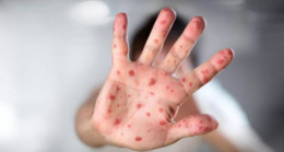 ABD’de kızamık alarmı! 20 bin kişi risk altında