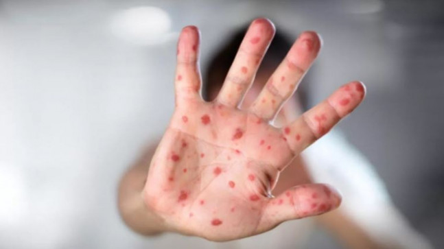 ABD’de kızamık alarmı! 20 bin kişi risk altında