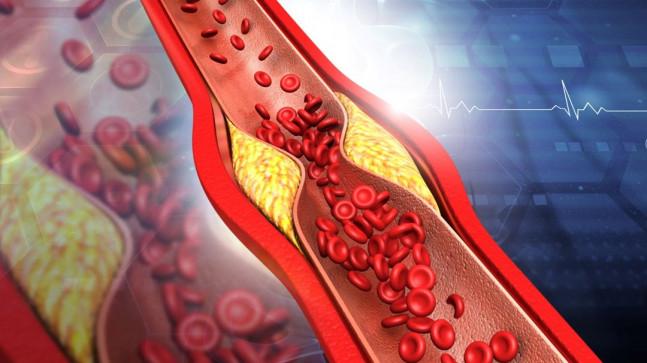 Araştırma: Yüksek seviyede kolesterol demansa yol açabiliyor
